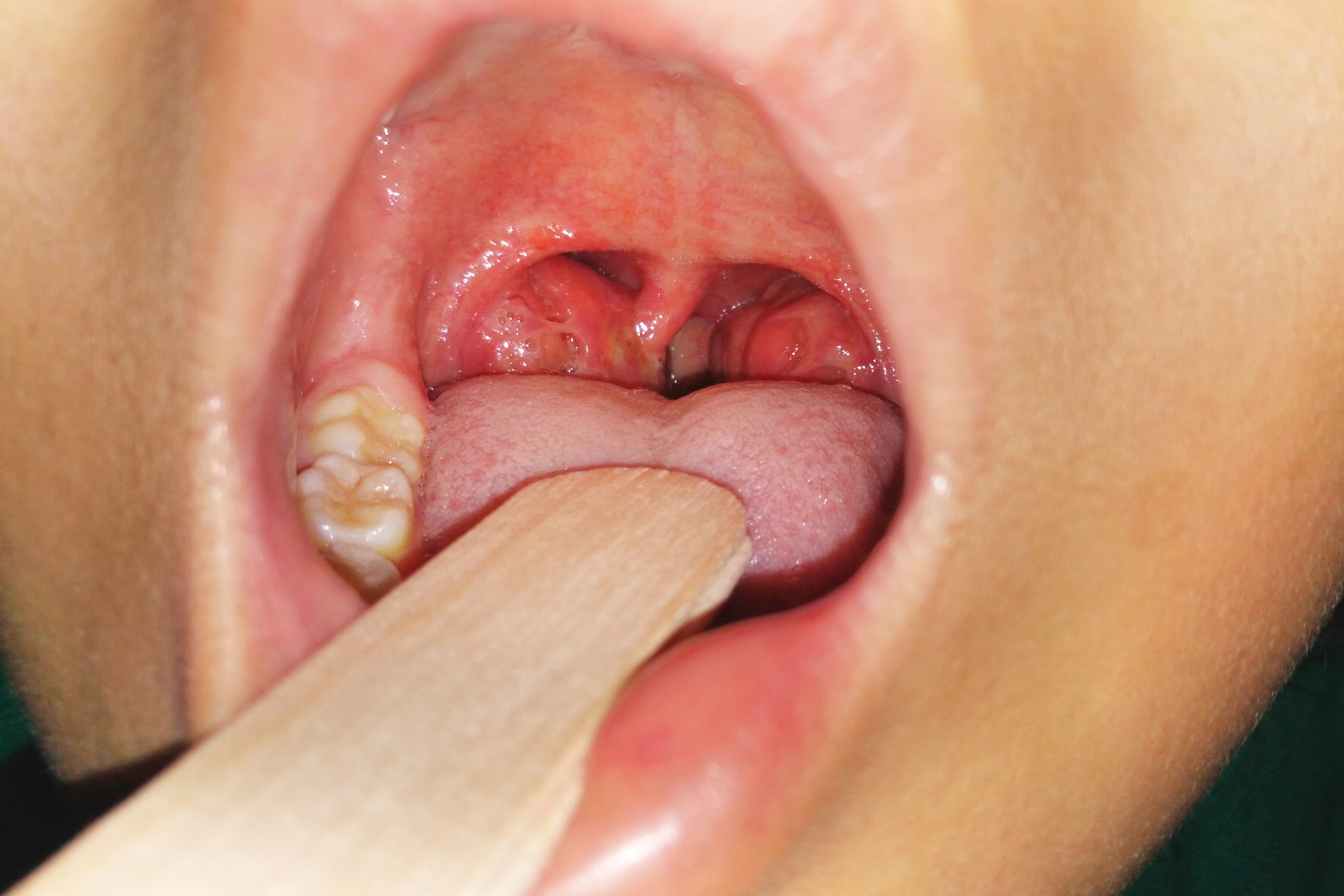tonsillitis